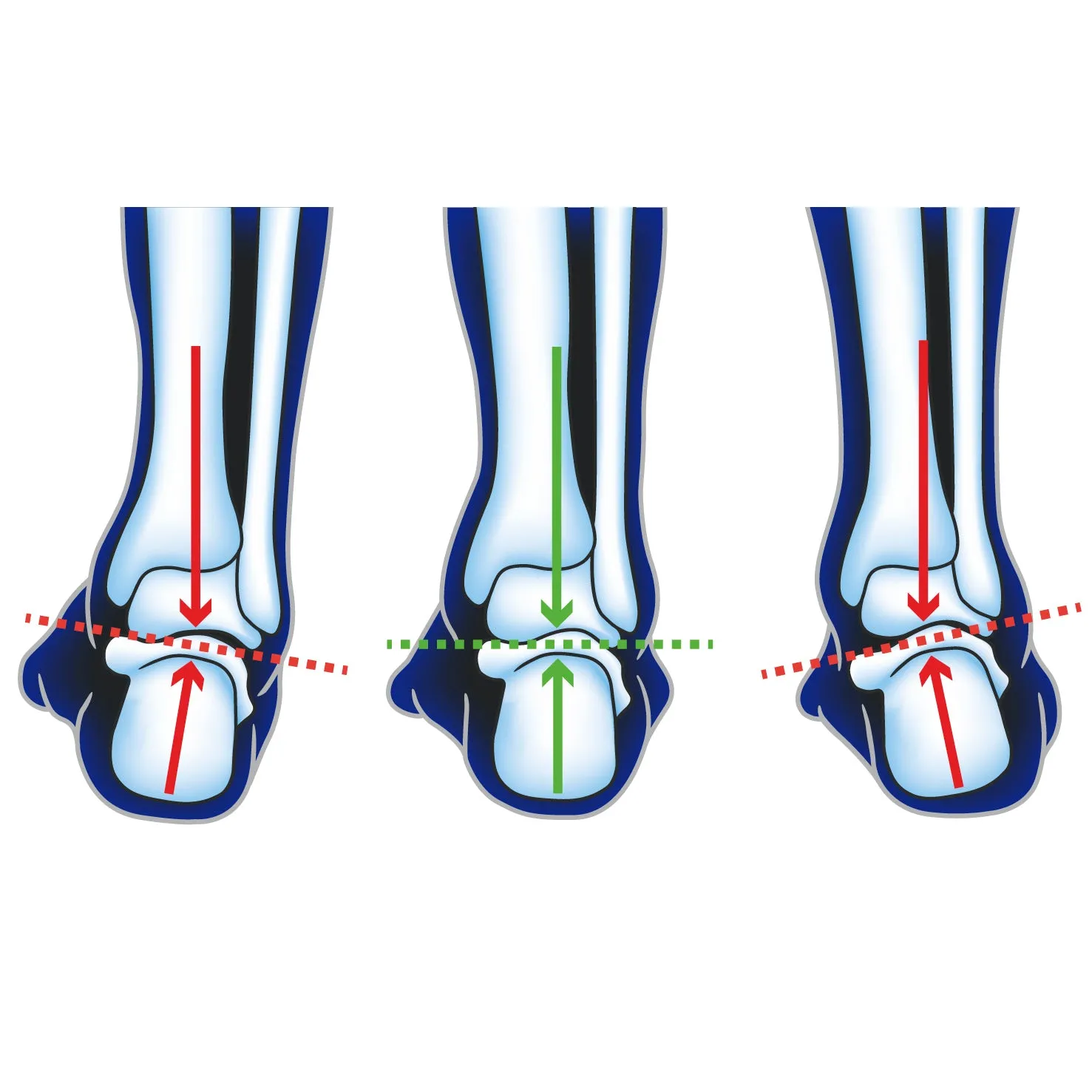 Ultimate Performance Advanced F3D Neutral Insole